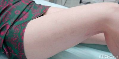 Сосуды близко к коже на ногах Сосуды близко к коже на ногах